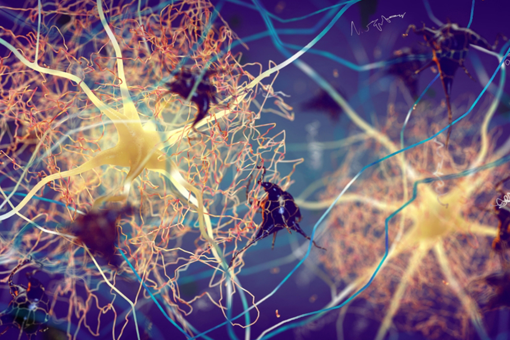 Amyloid plaques forming between neurons, 3d illustration. Beta-amyloid protein disrupting nerve cells function in a brain with Alzheimer's disease